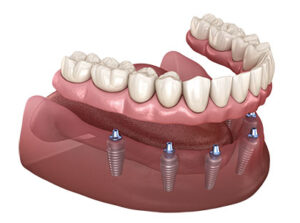 Dental implant 3-D illustration