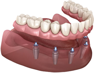 Dental implant 3-D illustration