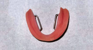 Denture with stanless steel stabilizers