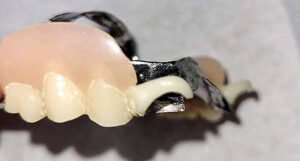 Partial denture with nylon clasps