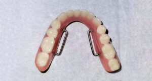 The underside of a shiny new lower denture wih stabilizers