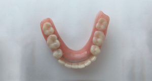 Stainless steel strengthener on lower dentures
