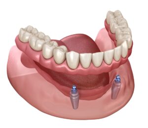 Non-fixed removable dentures